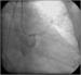 Abb. 9: Subakute Stentthrombose - Fallbericht