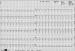Abb. 1: Rhythmische Schmalkomplextachykardie