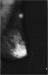Abb. 2: Mammographie - Knoten