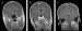 Abb. 1a-c: Hypertrophe chronische Pachymeningitis