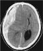 Abb. 1: Subdurales Hmatom