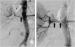 Abb. 1: Perkutane Angioplastie - Stentimplantation
