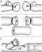 Aktuelles Bild - Abb. 2a-c: Vasektomie - Technik