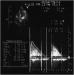 Abb. 4: Echokardiographie - CW-Doppler