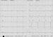 Aktuelles Bild - Abb. 1: AV-Rhythmus - U-Wellen