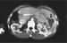 Abb. 2: Radiofrequenzablation - Tumor