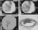 Abb. 4: Stentthrombose