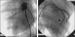 Abb. 5: Stentimplantation - Arterie