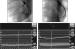 Abb. 6: In-Stent-Stenose - Pressure-Wire-Untersuchung