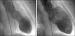 Abb. 2: Apical Ballooning
