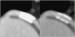 Abb. 4a: Koronarer Stent