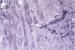 Aktuelles Bild - Abb. 2b: Immunhistochemie/Endomyokardbiopsie