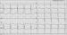 Abb. 2: Intraventrikulre Dyssynchronie