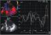 Aktuelles Bild - Abb. 3: Intraventrikulre Dyssynchronie