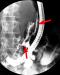 Abb. 1: Fistel vom D. pancreaticus in die Bursa omentalis reichend