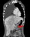 Abb. 2b: Coronale MDCT-Rekonstruktion der Fistel