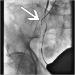 Abb. 5: A. femoralis communis sin.