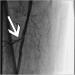 Aktuelles Bild - Abb. 7: Implantierter Stent