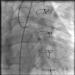 Abb. 4: Saphena Vena Graft auf die Arteria circumflexa (RAO 60/0)