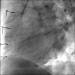 Abb. 6: Saphena Vena Graft auf die rechte Kranzarterie (RAO 60/0)