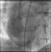 Abb. 7: Direkt-Stenting