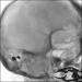 Abb. 2: Intrazerebrale Angiographie