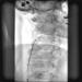 Abb. 5: Stent - Freisetzung