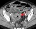Abb. 1: Tumor - Ileum