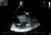 Abb. 2: Rechtsatriale Thrombose nach 2-Kammer-Schrittmacherimplantation