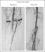 Abb. 1: Ballon-Angioplastie
