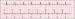 Abb. 1: SSS - Stimulation
