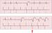 Abb. 2: SSS - Stimulation