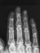 Abb. 1: Osteoporose - Radiologie