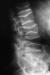 Abb. 4: Osteoporose - Radiologie