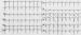Abb. 1: 12-Ableitungs-EKG