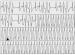 Abb. 3: Breitkomplextachykardie