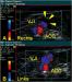 Abb. 2: Vena jugularis - Thrombose