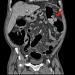 Aktuelles Bild - Abb. 1a: Colon descendens - Tumor