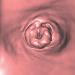 Abb. 1b: Colon descendens - Tumor