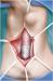 Abb. 1: Kollagenimplantat - Bulbre Harnrhre