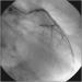 Abb. 7: Kissing-Ballon - RAO-Projektion