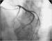 This Image - Fig. 1: Coronary angiography