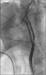 Abb. 4: Filter wire - Ballon