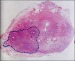 Abb. 1: Prostatakarzinom