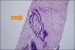 Abb. 3: Perineurale Tumorinfiltration