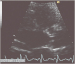 Abb. 3: LVOT-Diameter
