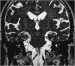 Abb. 2: Nervus trigeminus - Arteria cerebelli superior