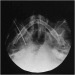 Abb. 5: Elektrodenspitze - Foramen ovale
