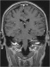 Aktuelles Bild - Abb. 10: Arteria cerebelli - Nervus vagus - Nervus glossopharyngeus