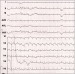 Abb. 1: EKG